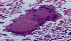 Histopathology showing a foreign body giant cell containing central nuclei
