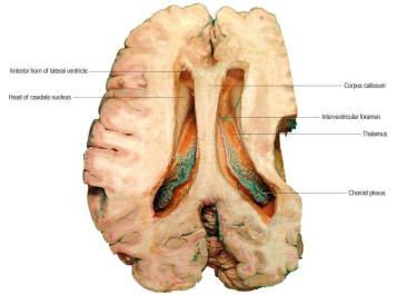 Horizontal Brain Section Dissection of Lateral Ventricles
