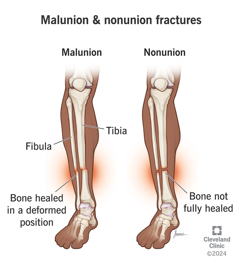 Illustrations comparing tibial malunion and non-union fractures