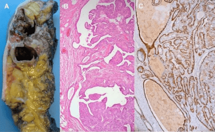 Intraductal papilloma