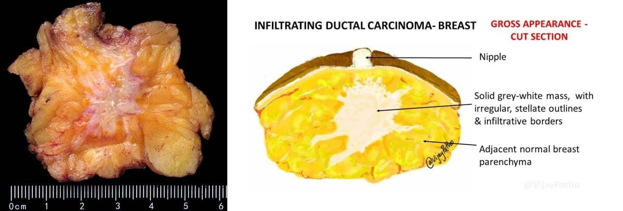Invasive ductal carcinoma of the breast gross resection 1