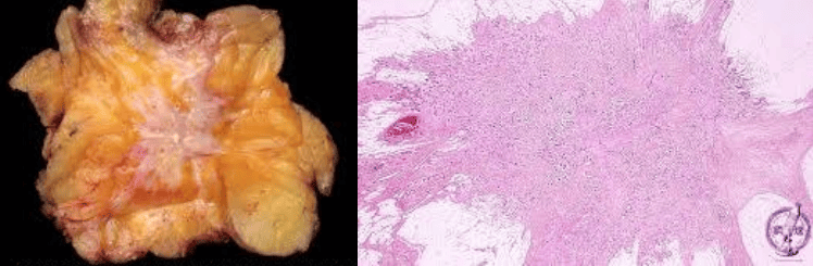 Invasive ductal carcinoma of the breast histology and desmoplasia