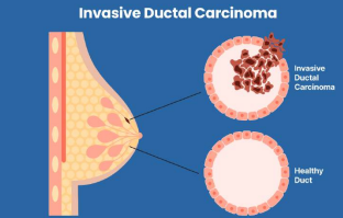 Invasive ductal carcinoma vs normal duct schematic