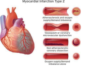 Classification mechanisms of Type 2 Myocardial Infarction