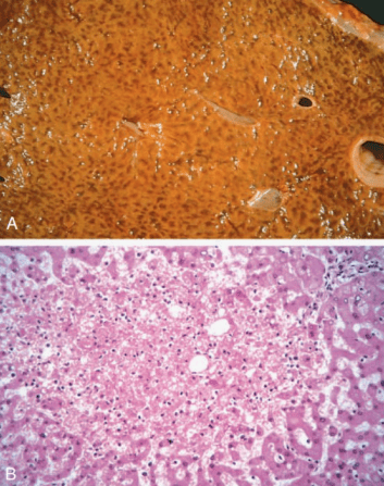 Nutmeg Liver Macroscopic Cut Surface and Histology of Centrilobular Necrosis