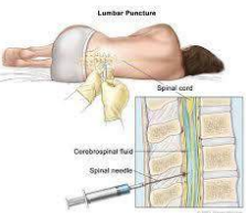 Lumbar puncture procedure for CSF collection