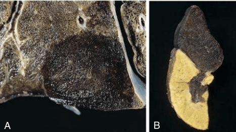 Macroscopic Comparison of Red Pulmonary Infarct and White Splenic Infarct