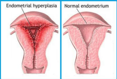 Macroscopic comparison of normal endometrium and endometrial hyperplasia