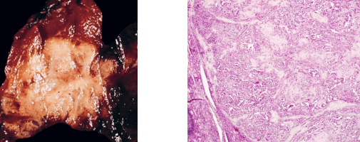 Medullary Carcinoma Gross and Microscopic