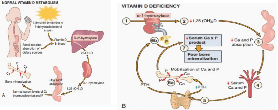 Metabolic pathway diagram comparing normal vitamin D homeostasis with the pathophysiological cascade of vitamin D deficiency and secondary hyperparathyroidism
