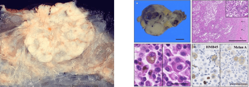 Metastasis: Breast carcinoma and lymph node metastasis