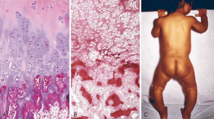 Microphotographs of normal versus rachitic costochondral junctions and clinical photograph of infant with severe bowing of legs