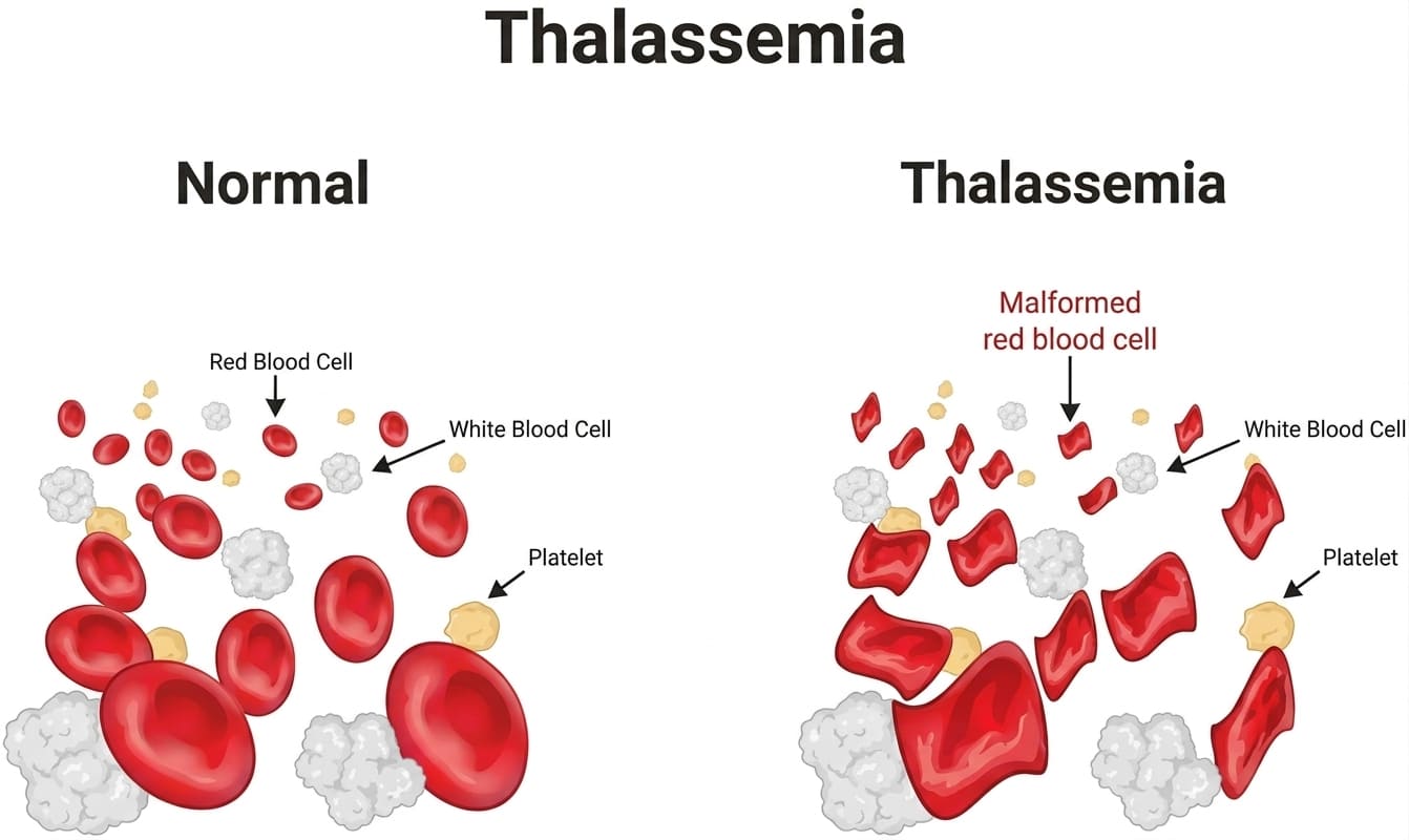 Microscopic Morphology in Thalassemia