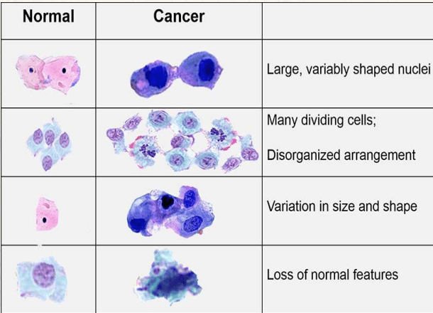 Microscopic comparison between normal cytology and malignant cytology