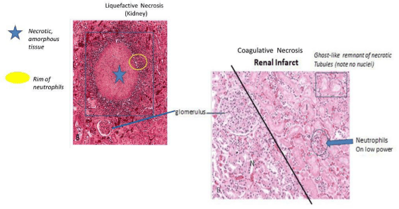 Microscopic histology comparing renal liquefactive and coagulative necrosis