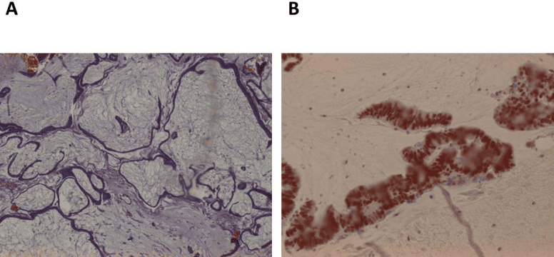 Microscopic histology of mucinous adenocarcinoma and CDX2 immunohistochemistry