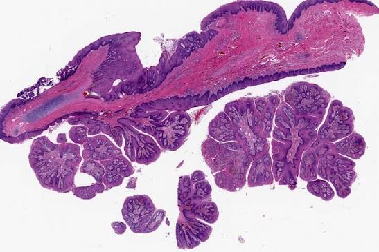 Microscopic histology of squamous cell papilloma