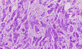 Microscopic histopathology of invasive ductal carcinoma