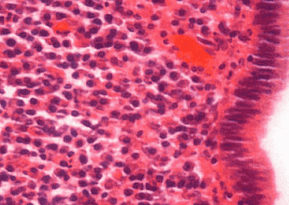 Microscopic view of chronic cervicitis showing dense mononuclear infiltration