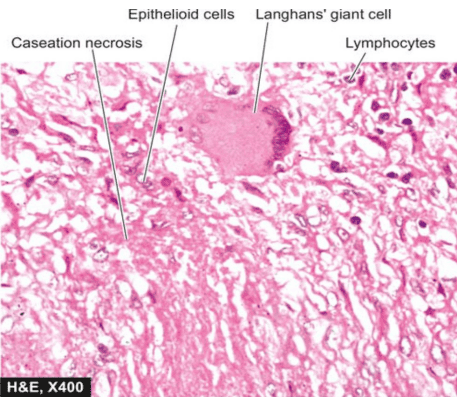 Microscopic view of tuberculous tubercle with central caseation necrosis