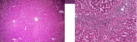 Microscopic views of normal hepatic parenchyma versus cirrhotic remodeling