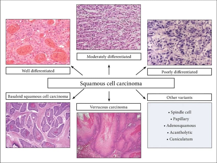 Morphological spectrum and histological variants of squamous cell carcinoma