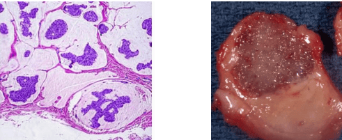 Mucin or Colloid carcinoma