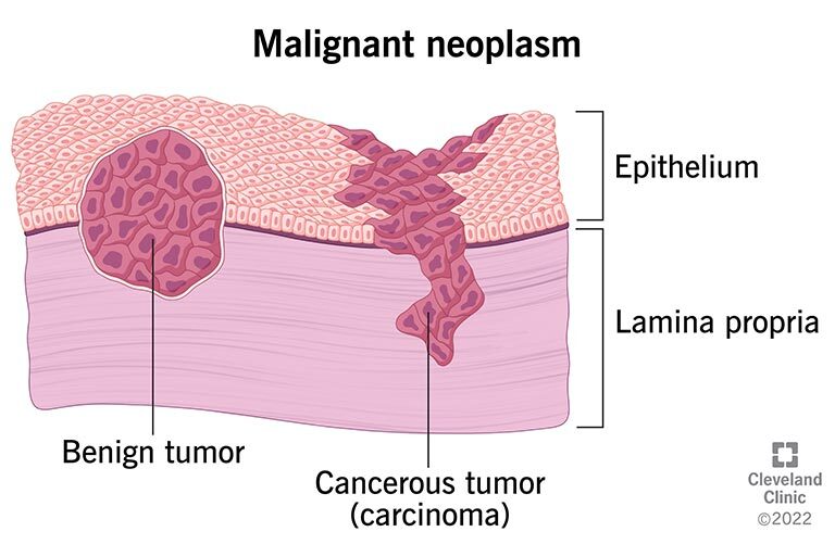 Neoplasia