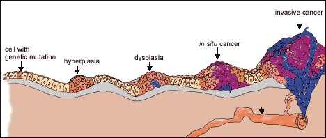 Neoplasia II & Oncology