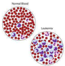 Normal blood film versus acute leukemia smear
