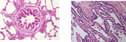 Normal bronchiole compared to pulmonary adenocarcinoma in situ