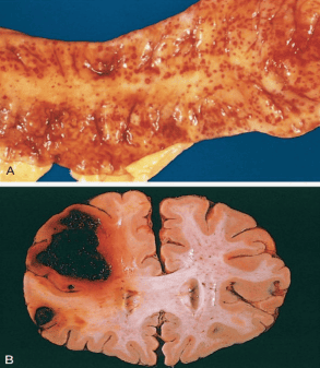 Petechial Mucosal Hemorrhage and Fatal Intracerebral Hematoma