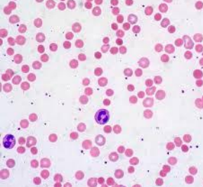 Peripheral Blood Smear of Hereditary Spherocytosis