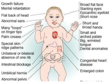 Phenotypic Features of Trisomy 21