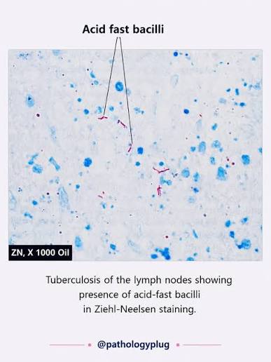 Photomicrograph of acid-fast bacilli on Ziehl-Neelsen stain of lymph node tissue