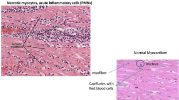 Photomicrograph of acute myocardial infarction showing coagulative necrosis and neutrophil infiltration