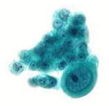 Photomicrograph of cytopathology cluster