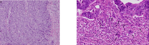 Poorly differentiated adenocarcinoma and Tumor Budding