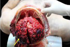 Post-mortem autopsy cranial examination