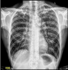Posteroanterior chest radiograph showing pulmonary tuberculosis cavitation