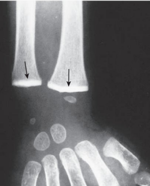 Radiograph of pediatric wrist demonstrating dense radiopaque transverse bands in metaphyses