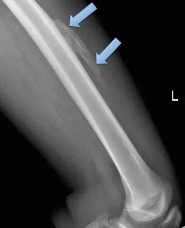 Radiograph of post-traumatic myositis ossificans along the femur