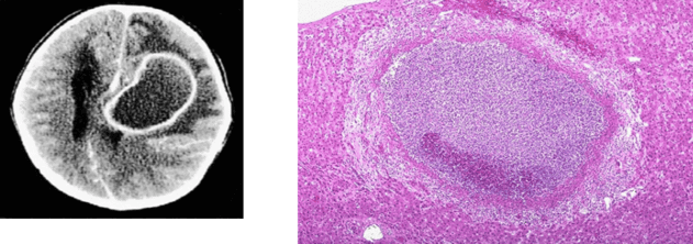 Radiological and Histological Characteristics of an Abscess