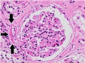 Renal amyloid deposits on H&E and Congo Red staining
