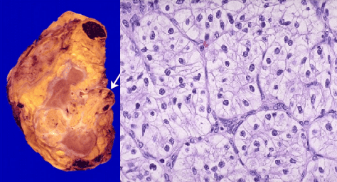 Renal cell carcinoma Invasion and Clear Cell Histology
