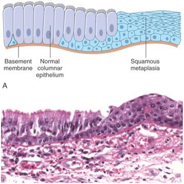 Schematic and histological progression of bronchial squamous metaplasia