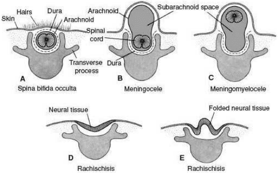 Neural tube defects transverse sections