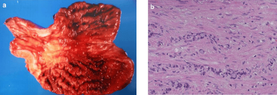 Scirrhous Carcinoma of the Stomach