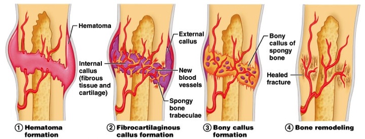 Sequential diagram of fracture healing stages: hematoma, soft callus, hard callus, and remodeling