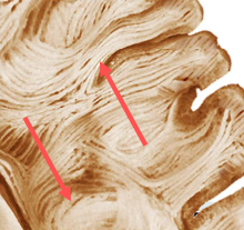 Axonal Shearing Pathology